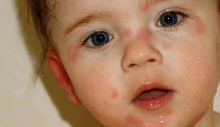 Диета при аллергии у ребенка: меню