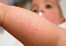 Диета при аллергии у детей разных возрастов