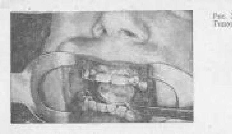 Заболевания твердых тканей зубов этиология и патогенез Явления, возникшие после прорезывания зубов