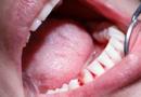 Чому ясна відходить від зуба
