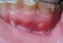 Nướu cuối hàm dưới hoặc hàm trên đau và sưng tấy: răng khôn mọc phải làm sao?