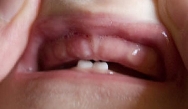 Răng hàm mọc ở trẻ bị sốt
