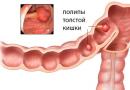 Poliepen in de darmen - eerste symptomen en manifestaties, behandeling
