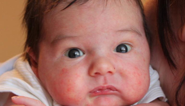 Обрив по тялото на бебето - преглед на възможните причини и заболявания