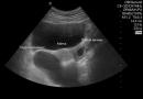 Ang mga posibilidad ng ultrasound sa pagtukoy ng mga sanhi ng tubal obstruction