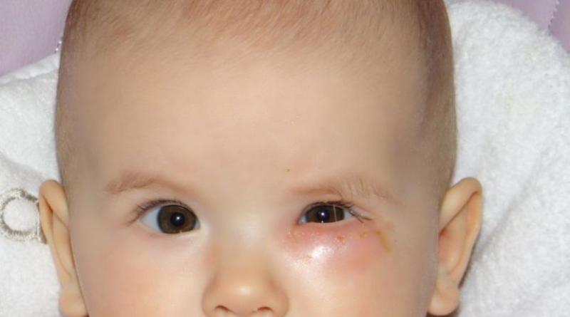 Menyelidik saluran lacrimal pada bayi baru lahir - bagaimana prosedurnya?