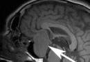 Jak objawiają się zaburzenia przysadki mózgowej?