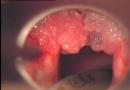 Papilóm v krku: príčiny, príznaky (foto), ako liečiť, odstránenie Čo je papilóm
