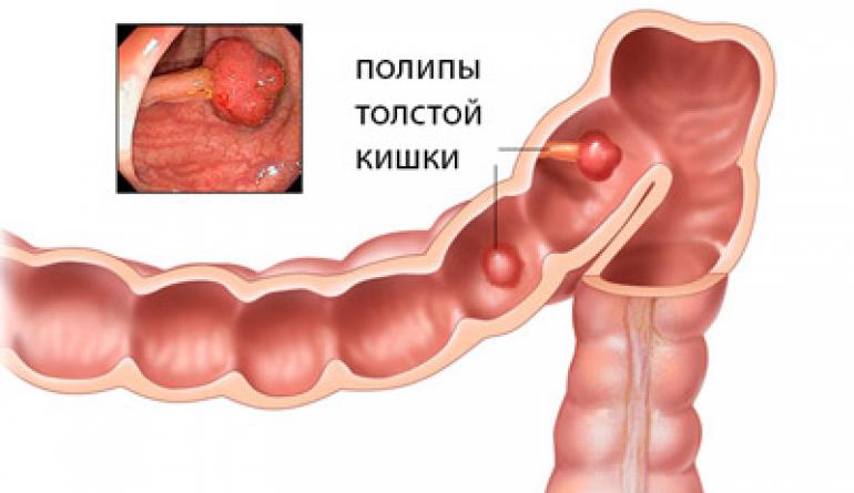 Полипы в кишечнике - первые симптомы и проявления, лечение