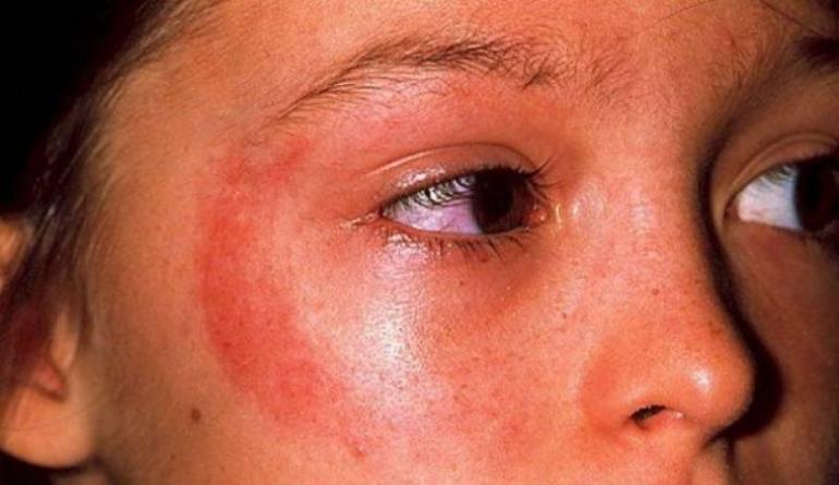 लहान मुलामध्ये सूर्यप्रकाशाची ऍलर्जी: लहान मुलांमध्ये आणि 1 वर्षापेक्षा जास्त वयाच्या मुलांमधील फोटोंसह लक्षणे, पुरळांवर उपचार
