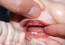 Як пережити появу перших зубів у дитини