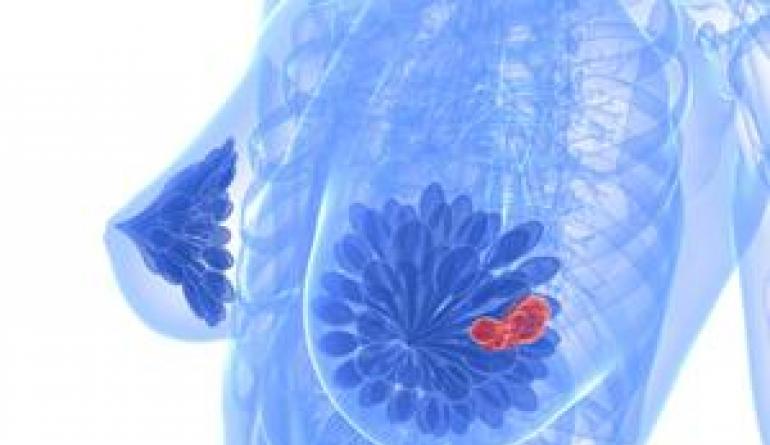 Mga sintomas at paggamot ng mastopathy ng mga glandula ng mammary