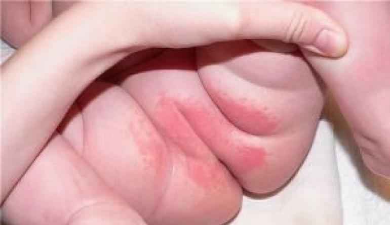 Всички възможни причини за обрив в слабините при дете, алергии като една от тях