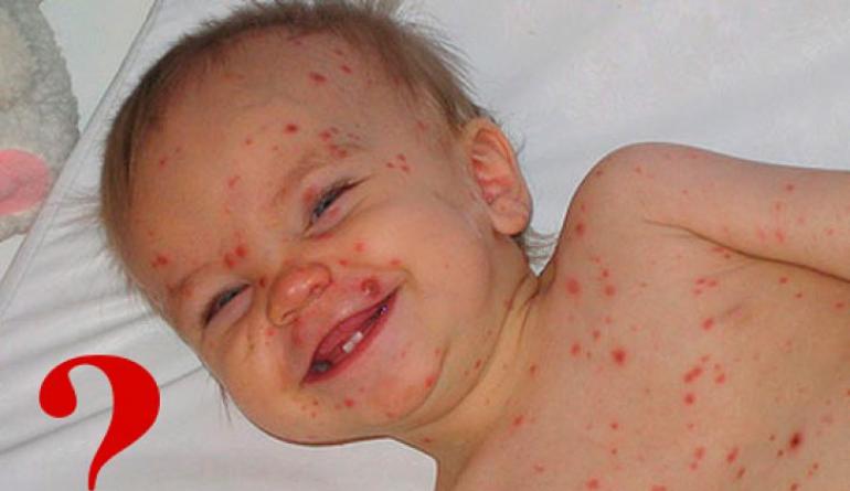 Herpes loại 6: triệu chứng và điều trị ở trẻ em và người lớn
