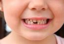Симптоми и особености на никнене на молари при деца Кога изникват постоянните зъби при децата?