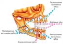 Прорізування корінних зубів у дітей: симптоми