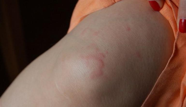 Wysypka na nogach zdjęcie z nazwą choroby Ból stawów pojawienie się wysypki