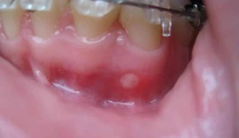 Венците в края на долната или горната челюст болят и са подути: какво да правите, ако расте мъдрец?