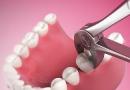 Herstelperiode na tandextractie, veel voorkomende problemen, tips Hoe kan ik een getrokken tand herstellen