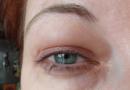 Причини появи ранкових набряків під очима та способи їх лікування