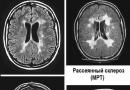 “Đốm trắng” và “chấm trắng” trên MRI - chúng là gì?