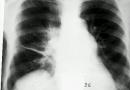 Плеврит на белите дробове: симптоми, лечение, усложнения