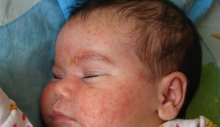 Przyczyny gronkowca u niemowląt, objawy i niebezpieczeństwo infekcji bakteryjnej