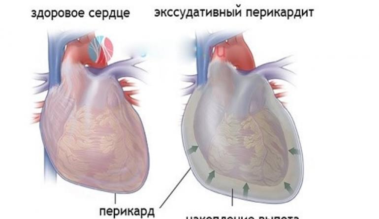 Viêm màng ngoài tim ở trẻ em - triệu chứng và điều trị