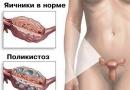 Polycystic ovaries - sintomas, sanhi at paggamot